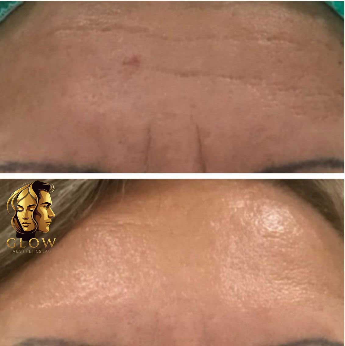 Skin Rejuvenation - Before