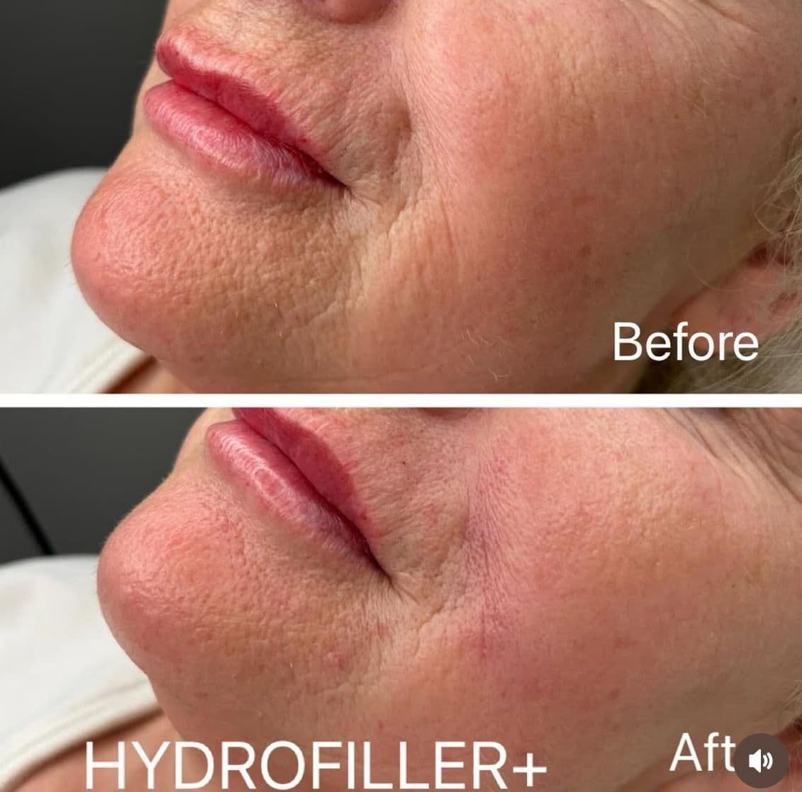Hydrofiller Treatment - Before