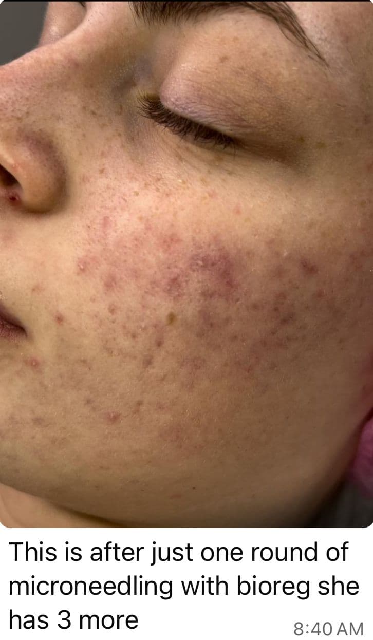 Microneedling - Before