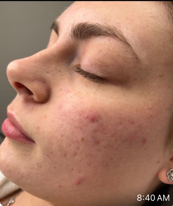Microneedling - After