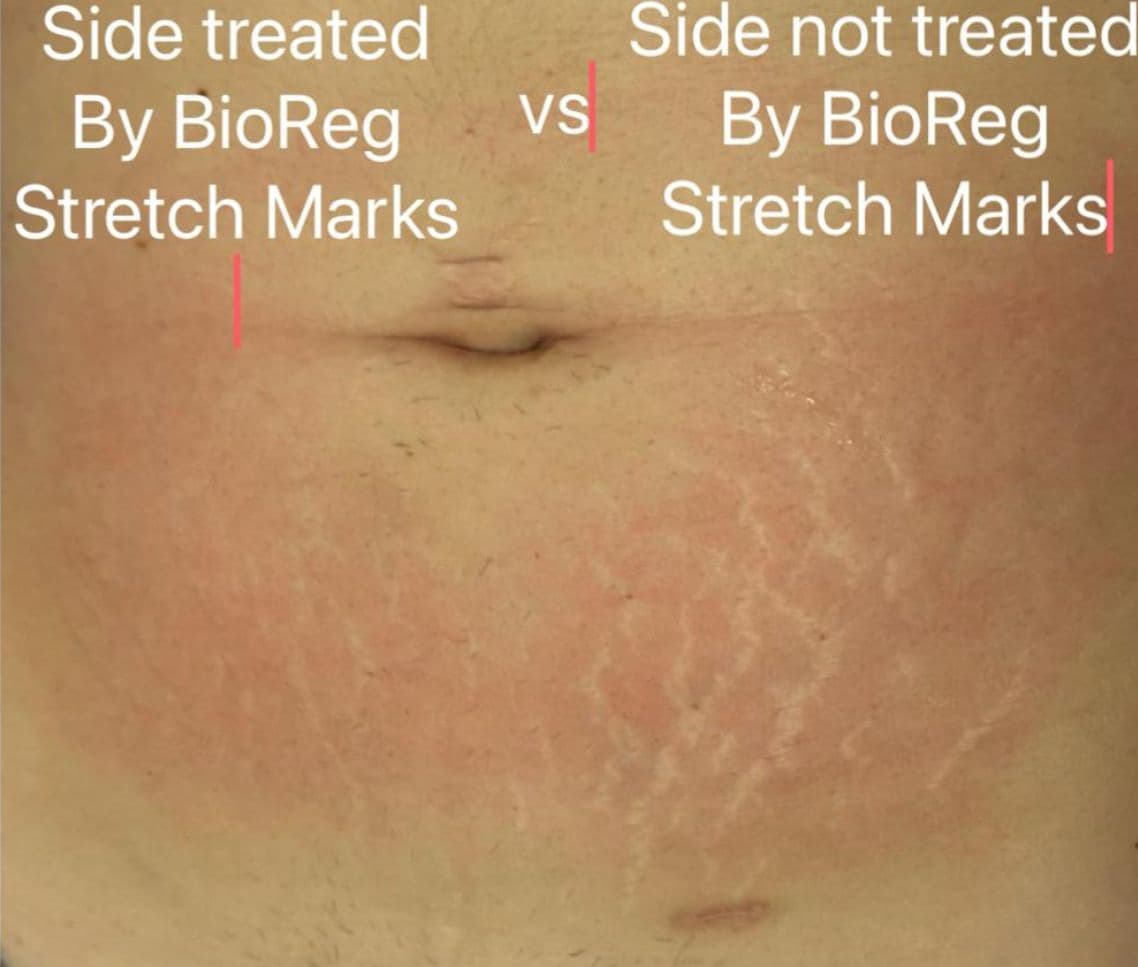 Stretch Mark Treatment