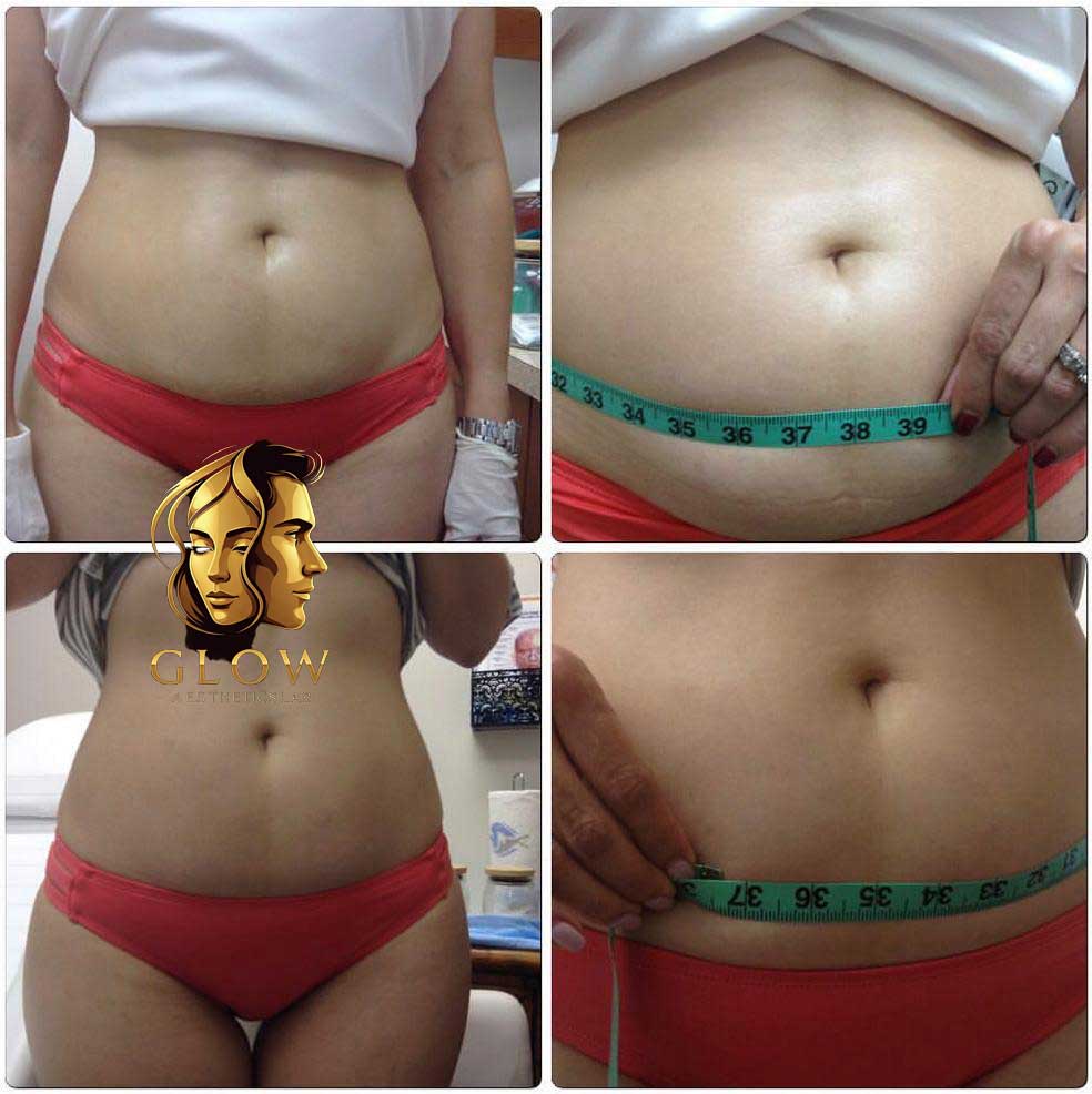 Fat Dissolving - Abdomen - Before